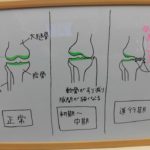 ◇変形性膝関節症　原因と治療◇