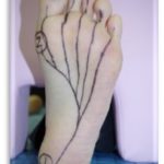 ◆巻き爪の原因と治療◆