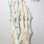 もしかして外反母趾?足の親指が痛い!