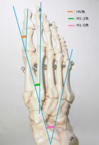外反母趾は親指の開いている角度によって程度が異なります。