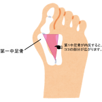 外反母趾ってどんな症状？
