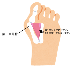 外反母趾ってどんな症状？
