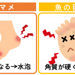 【ランナー必見】ランニング中に足のマメや魚の目ができる人の癖と対策