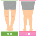 あなたのO脚のタイプ別診断