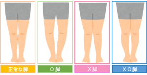 あなたのO脚のタイプ別診断